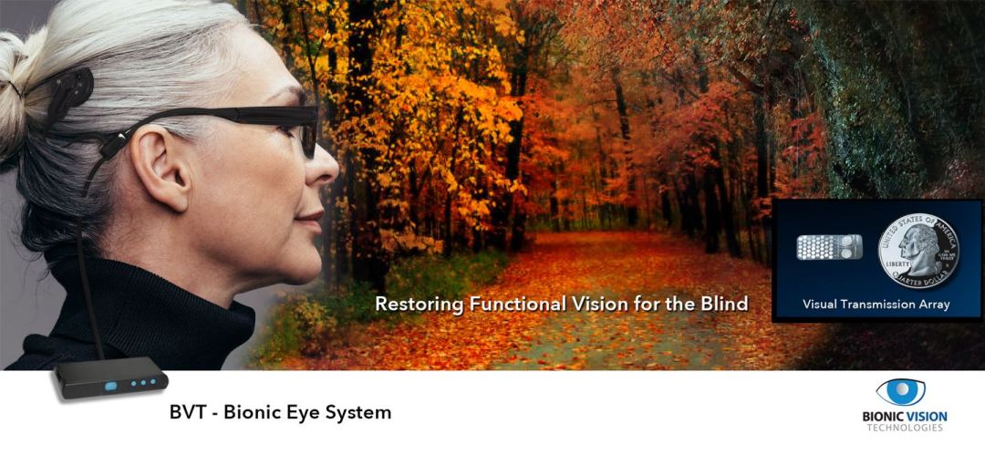Bionic Eye BVT Bionic Eye System. Restoring Functional Vision for the Blind