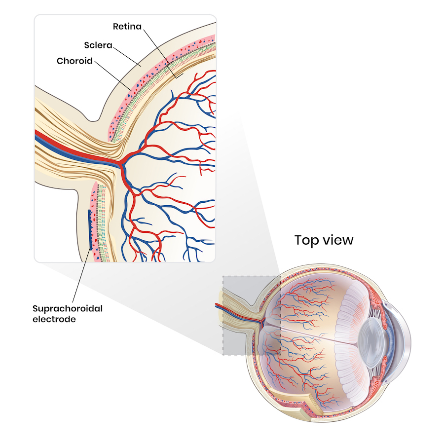 Location of the suprachoroidal electrode Anatomical illustration showing the location of the suprachoroidal electrode in the eye
